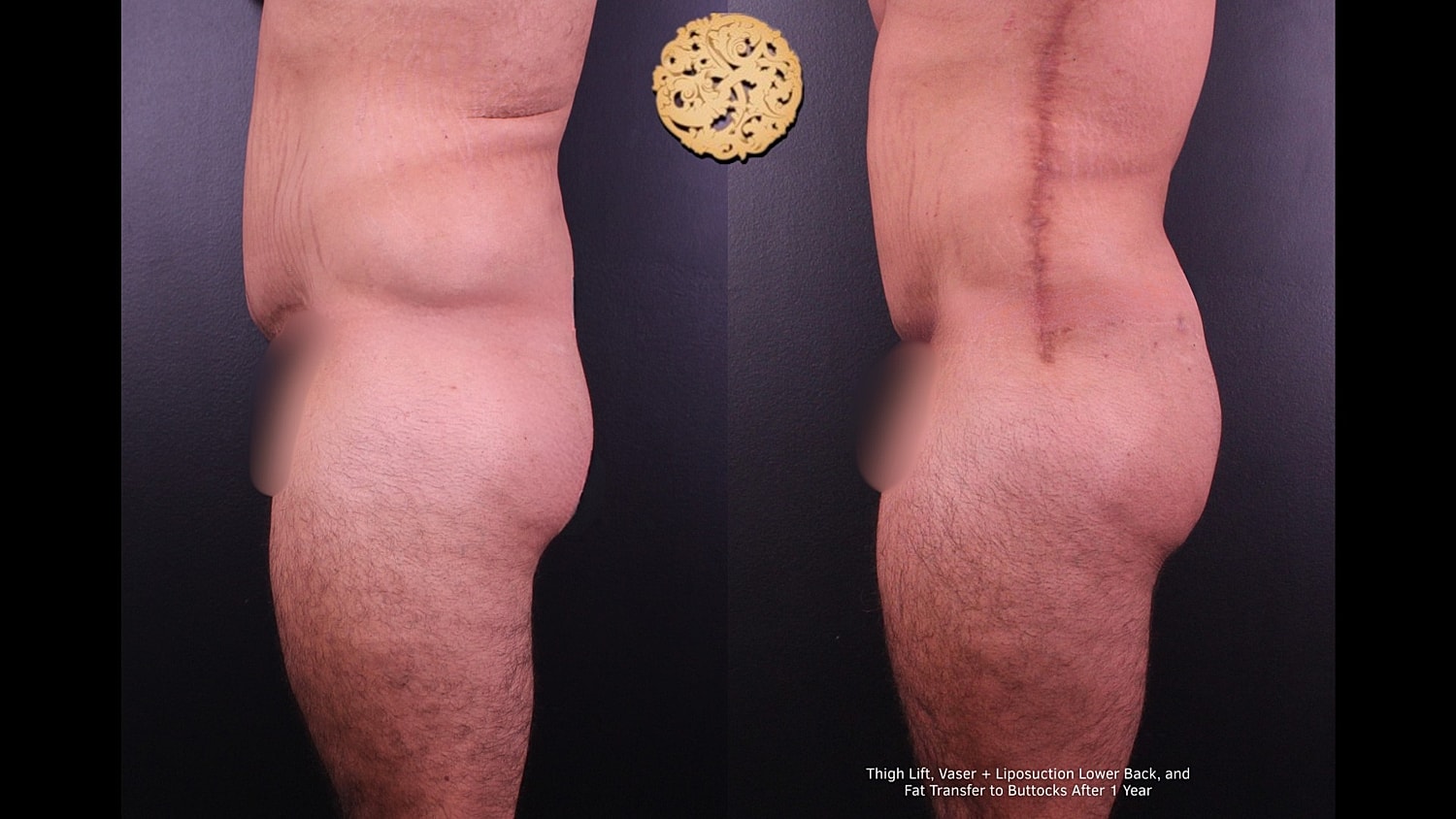 Before and after body contouring procedures