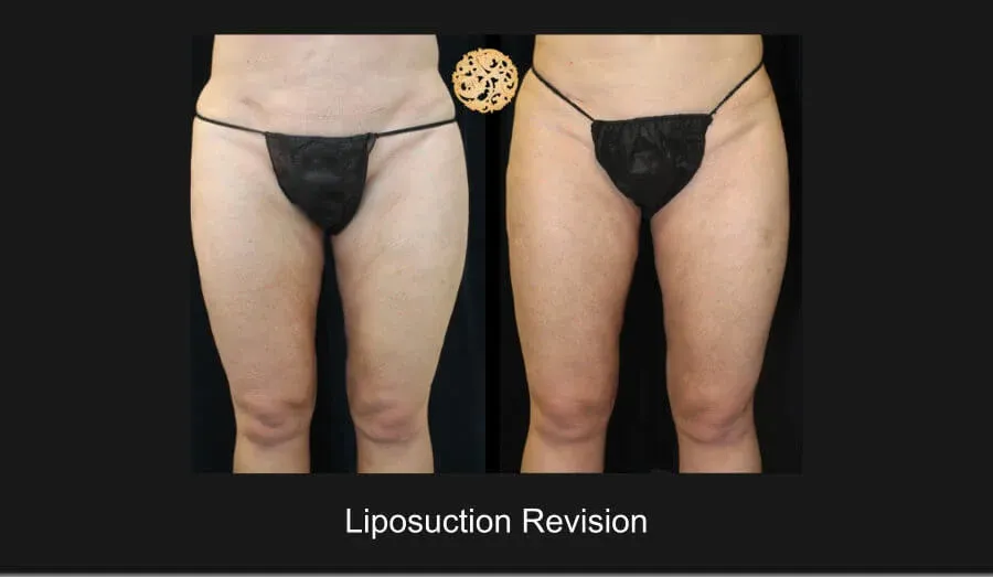 Liposuction Before & After