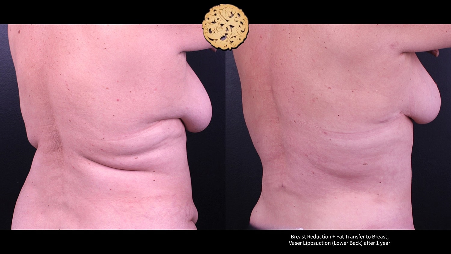 Liposuction Before & After