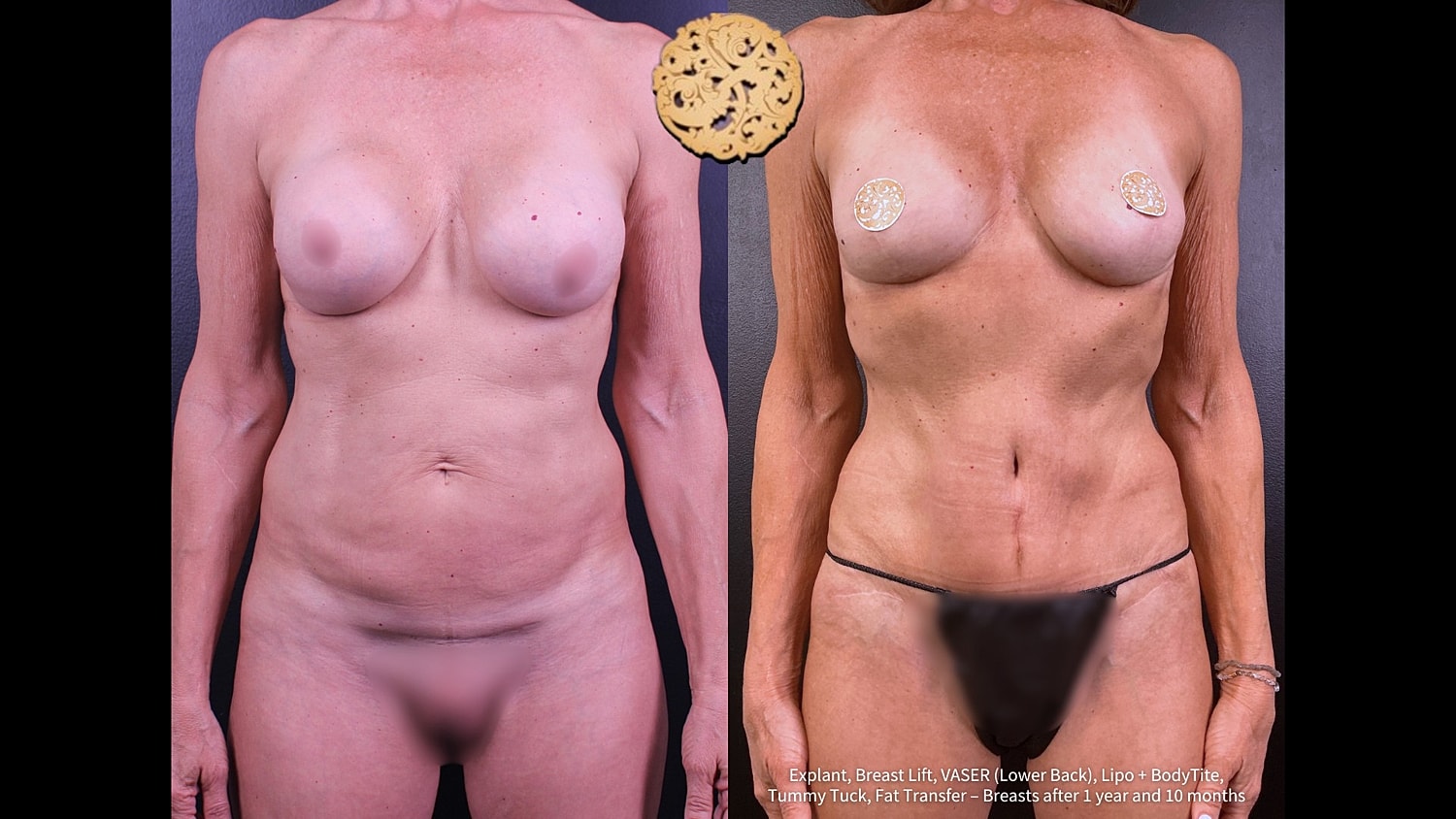 Liposuction Before & After