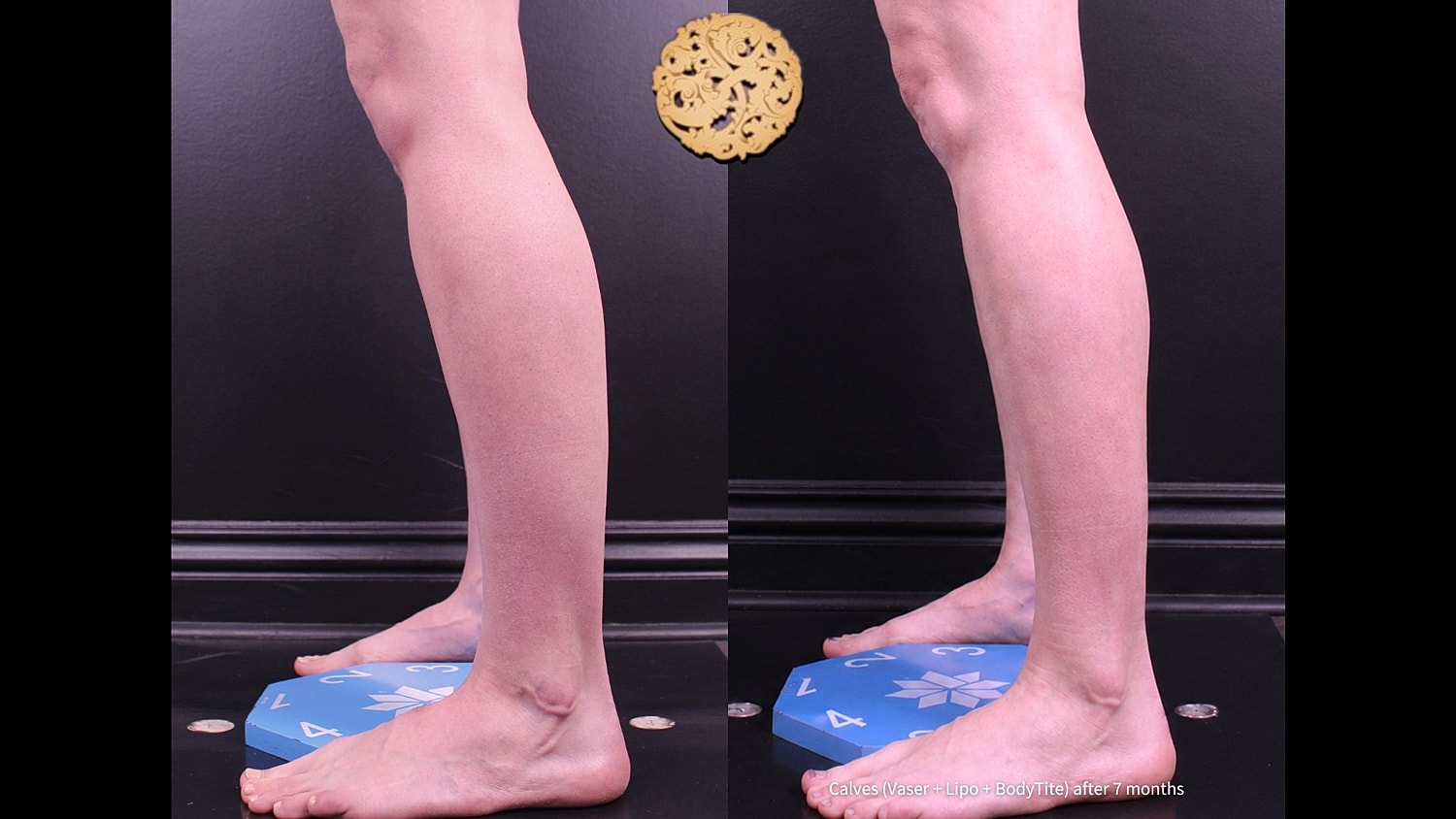 Calves ( Vaser + Lipo + BodyTite) after 7 months