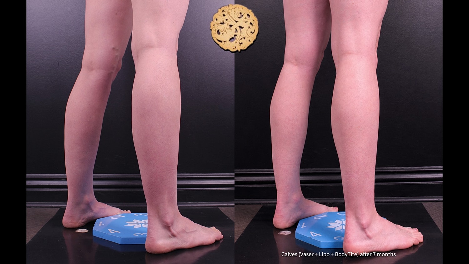 Calves ( Vaser + Lipo + BodyTite) after 7 months
