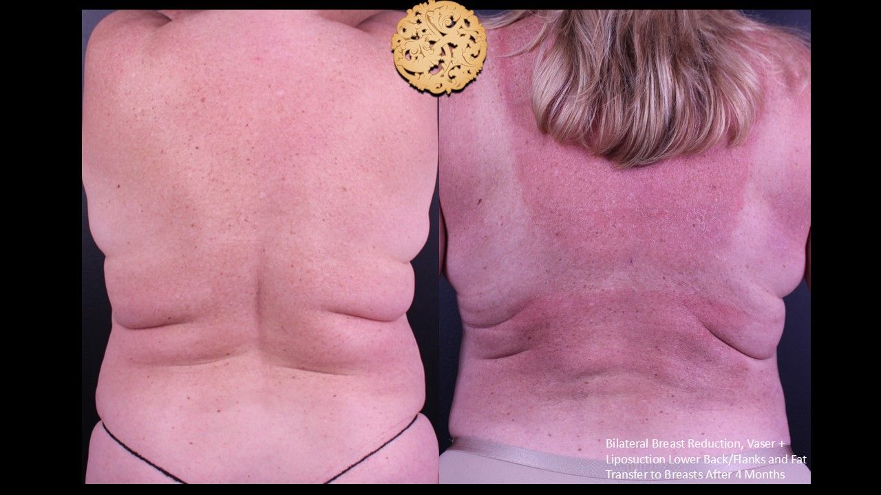 Liposuction Before & After