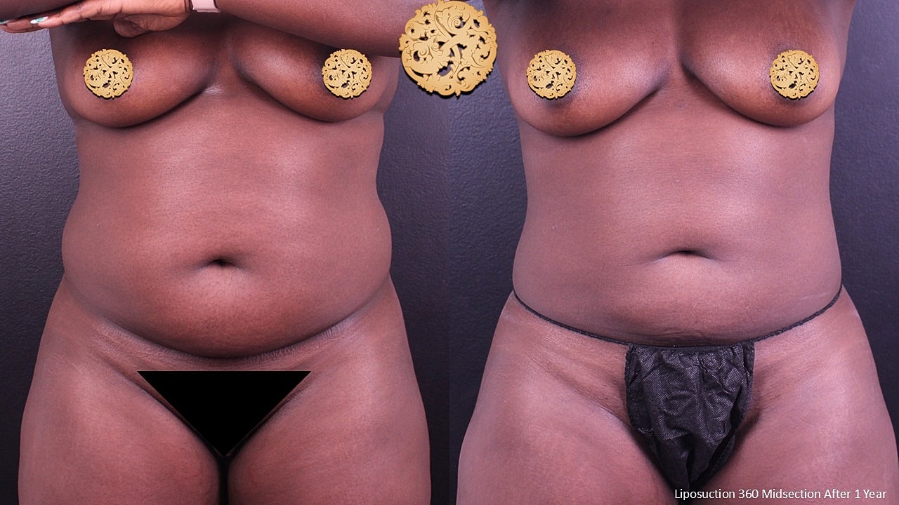 Liposuction 360 Midsection After 1 Year