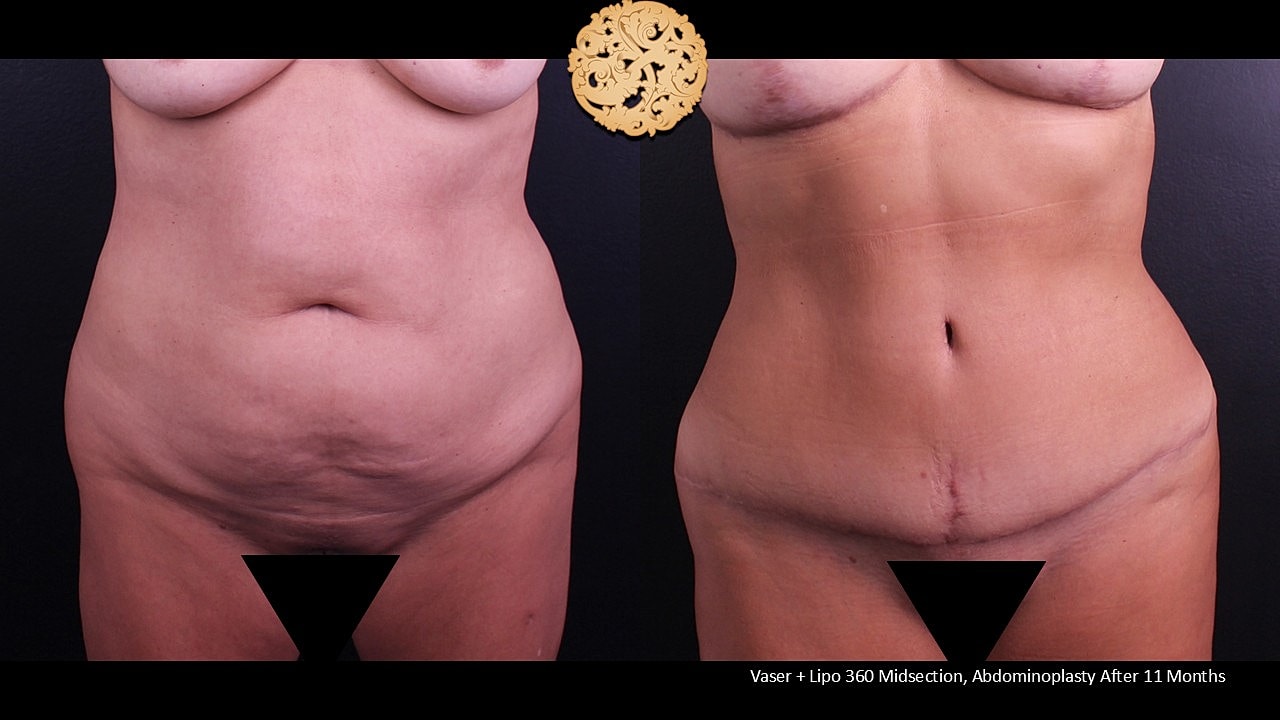 Before and after body contouring results.