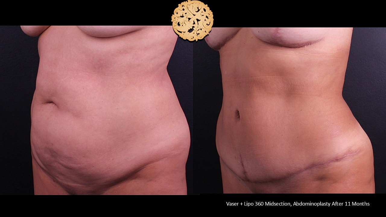 Before and after body contouring procedure photos.