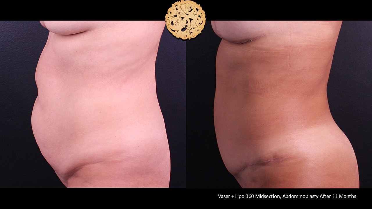 Before and after body contouring surgery results.