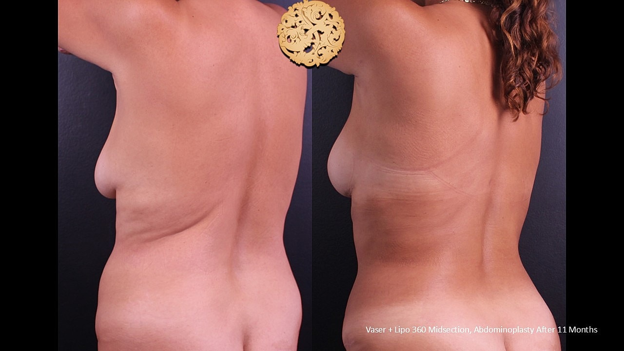 Before and after body contouring results comparison.