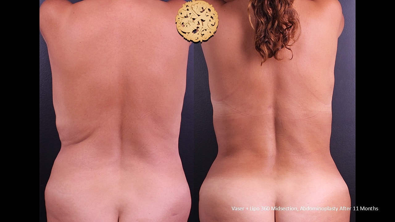 Before and after body contouring procedure comparison.