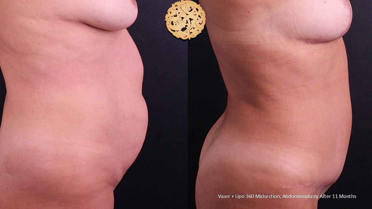Before and after abdominal body contouring surgery.