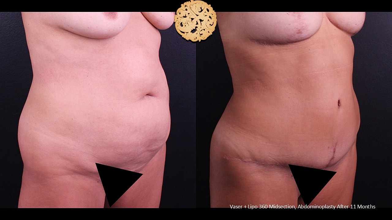 Before and after abdomen surgery comparison image.