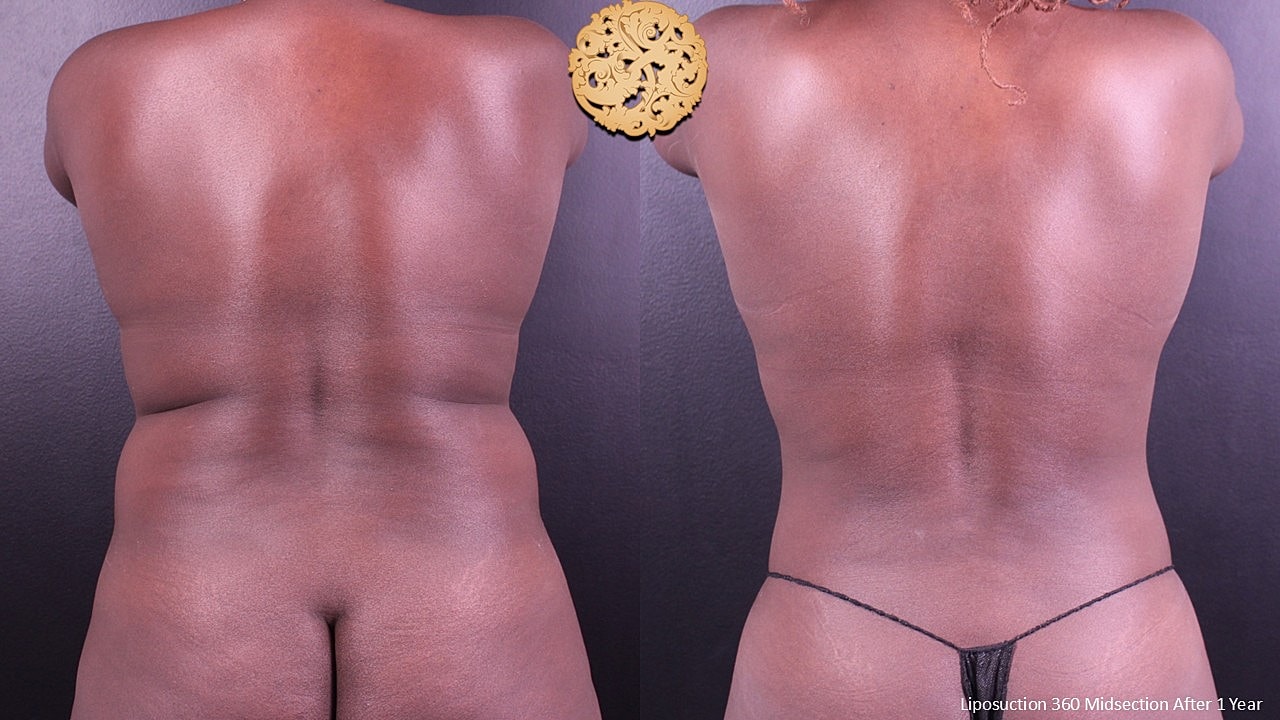 Liposuction 360 Midsection After 1 Year