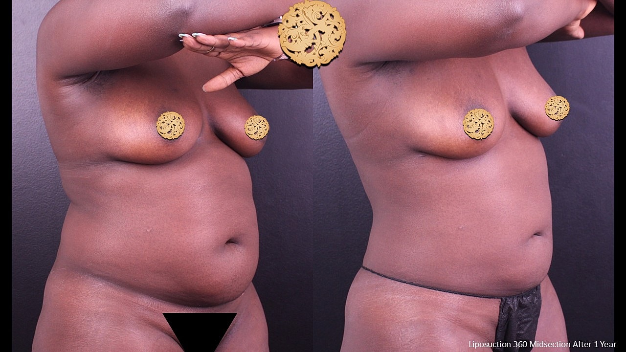 Liposuction 360 Midsection After 1 Year