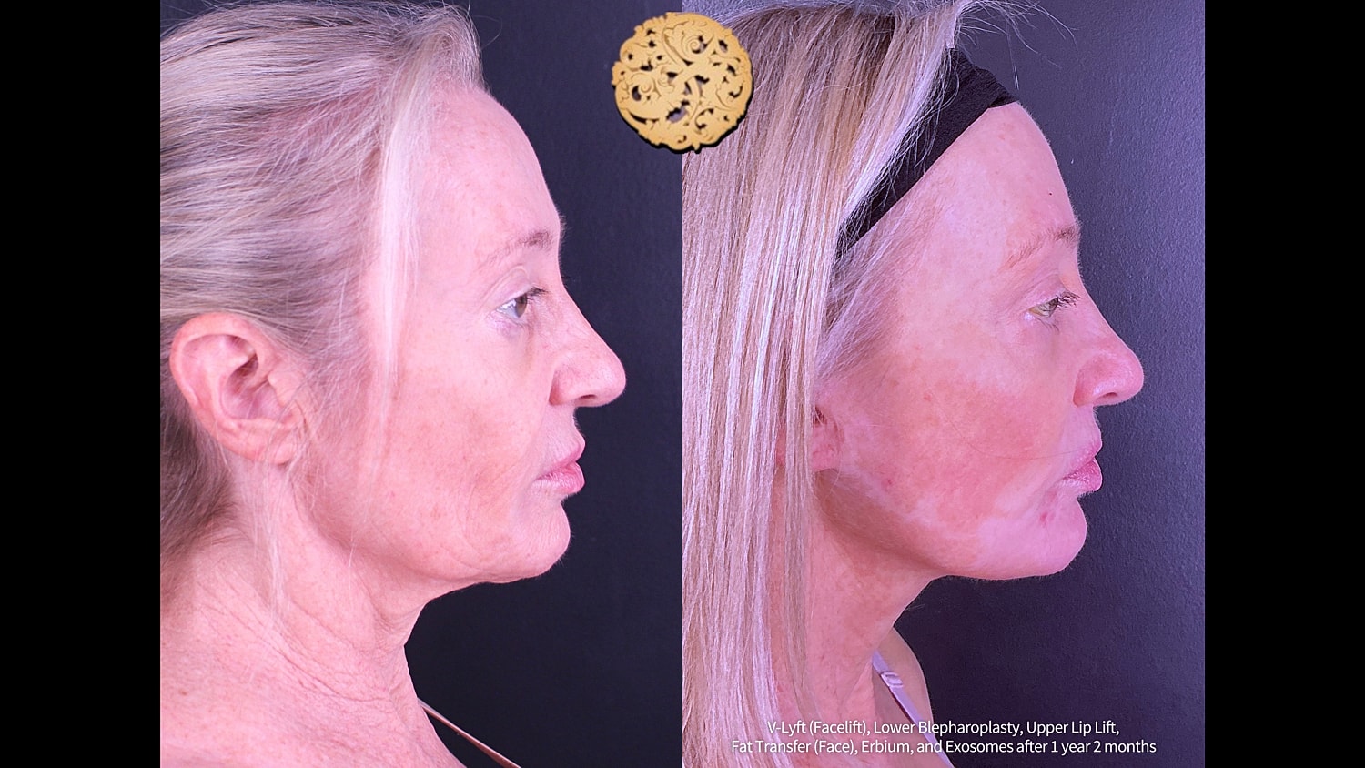 Before & After