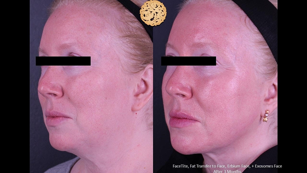 Facial transformation before and after treatment.