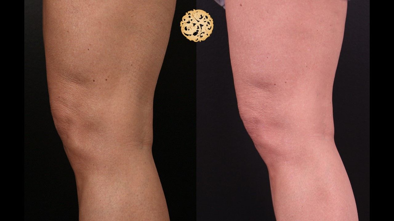 Morpheus8 Knees Before & After