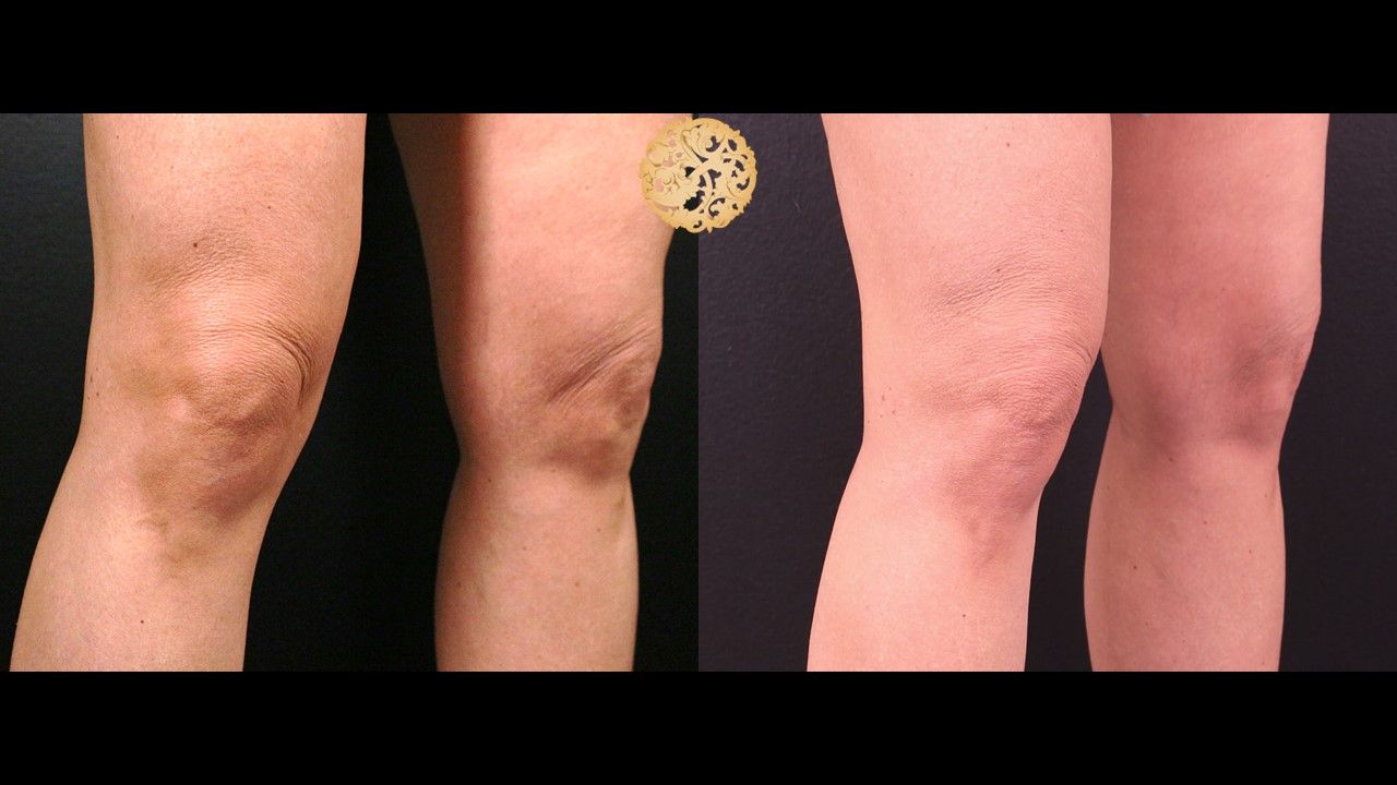 Morpheus8 Knees Before & After