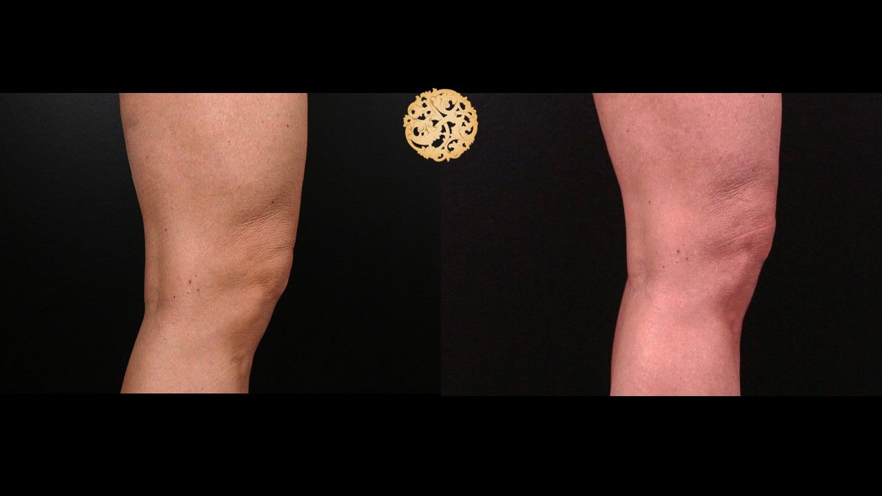 Morpheus8 Knees Before & After