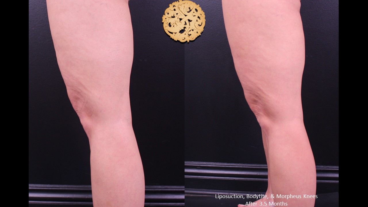 Morpheus8 Knees Before & After