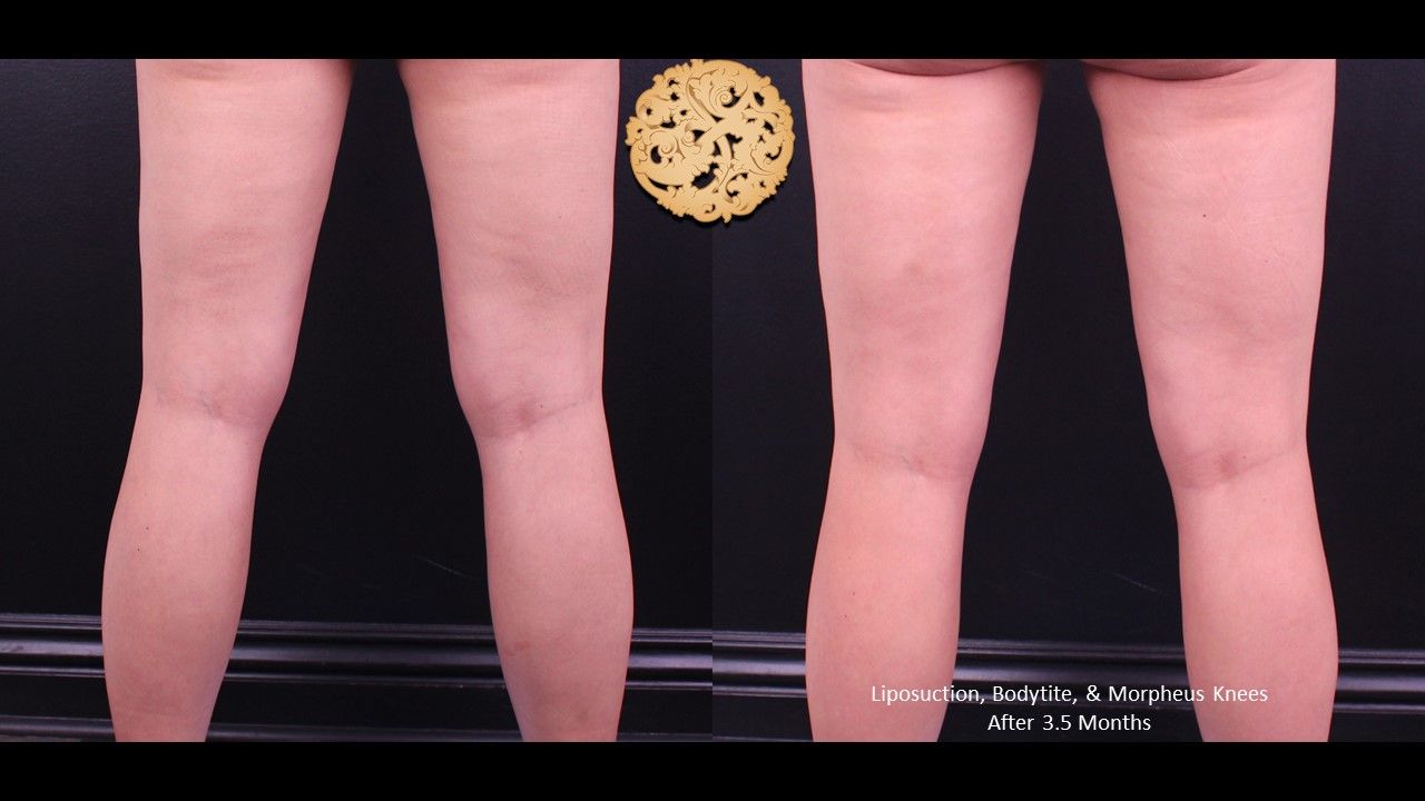 Morpheus8 Knees Before & After
