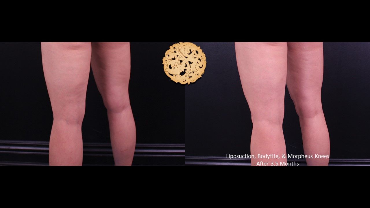 Morpheus8 Knees Before & After