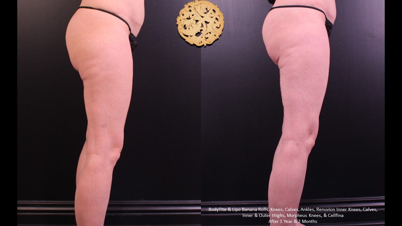 Morpheus8 Knees Before & After