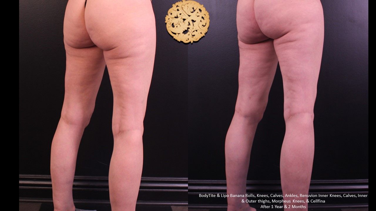 Morpheus8 Knees Before & After