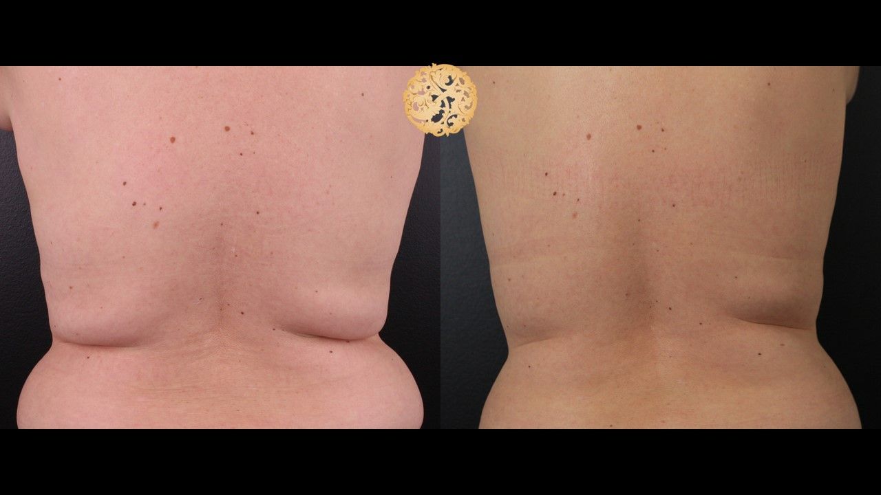 Back Coolsculpting Before & After