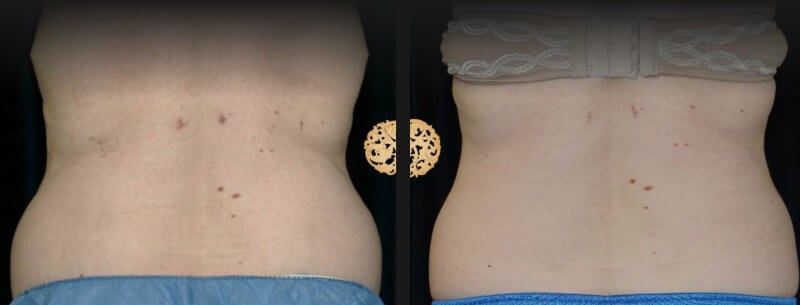 Back Coolsculpting Before & After