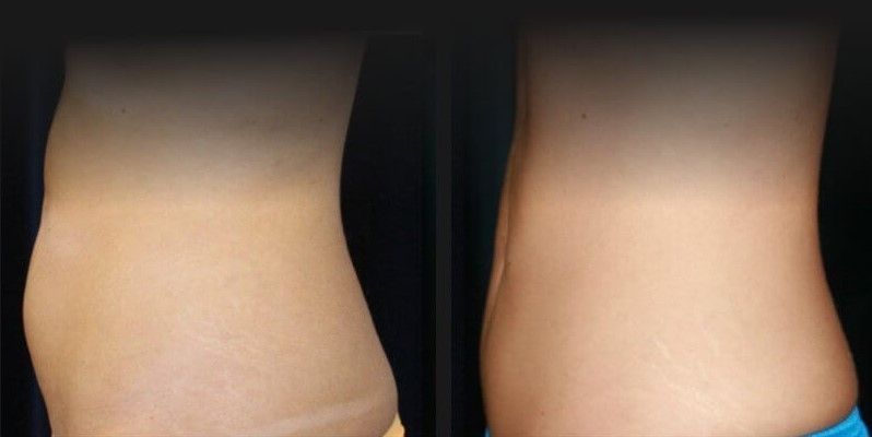 Back Coolsculpting Before & After