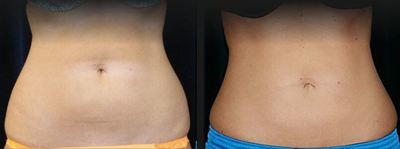 Back Coolsculpting Before & After