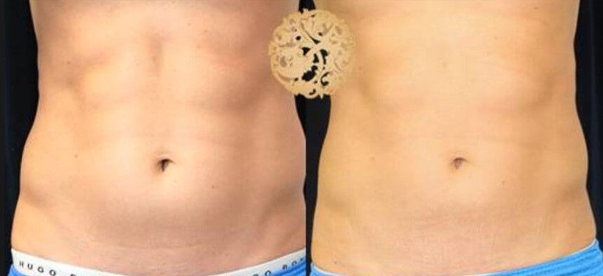 Back Coolsculpting Before & After