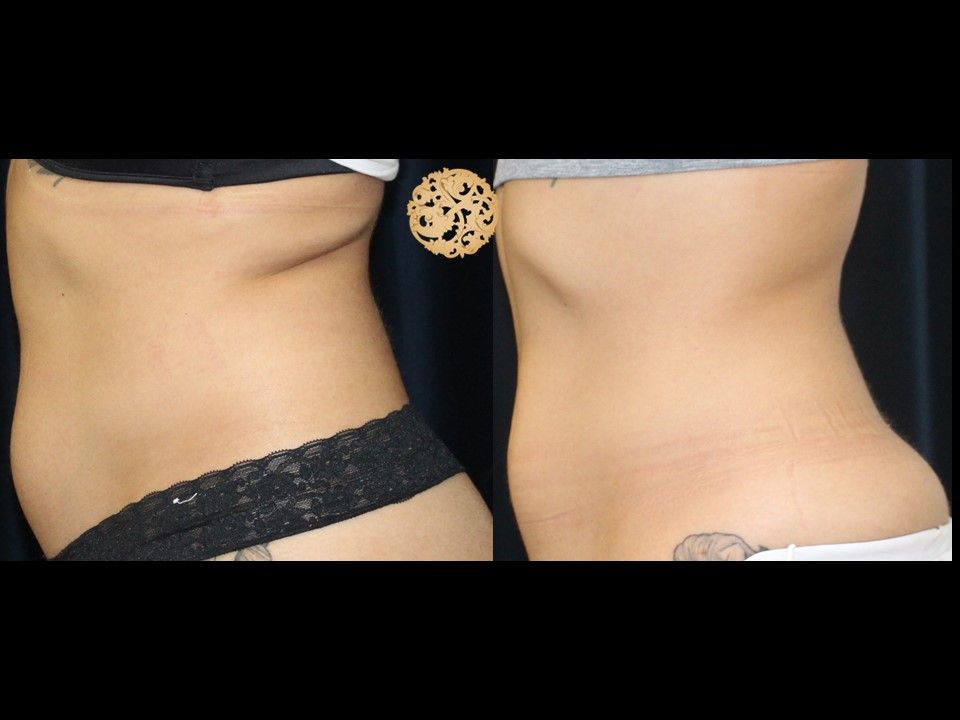Back Coolsculpting Before & After