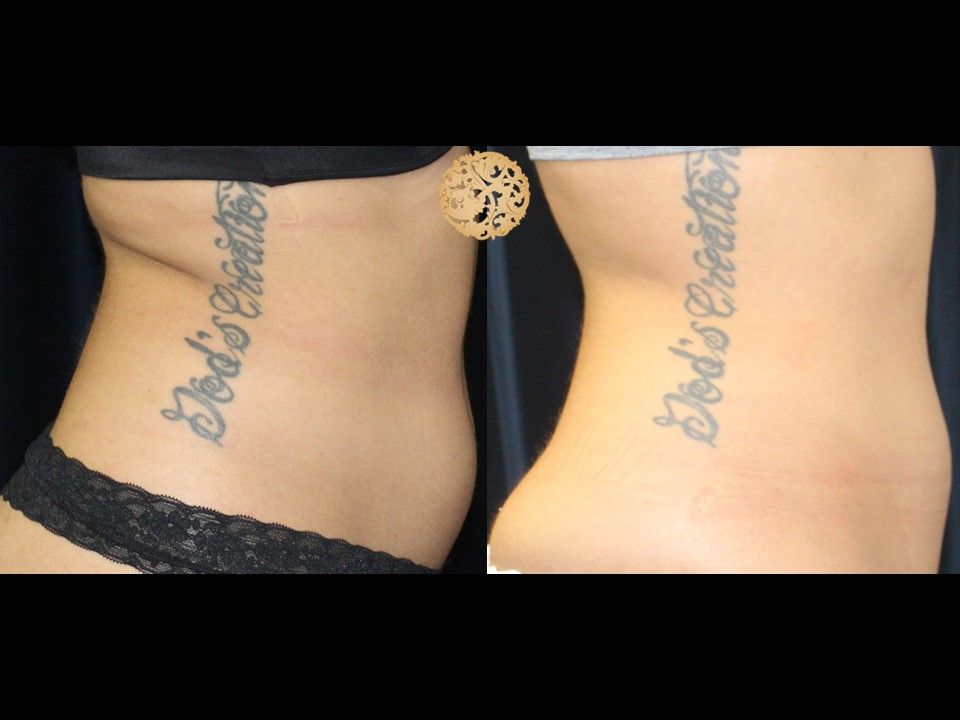 Back Coolsculpting Before & After