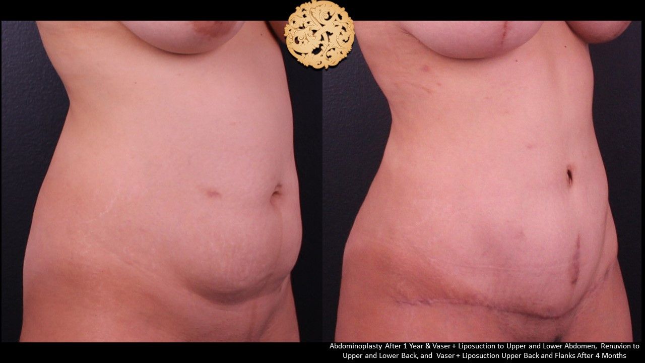 Liposuction Trunk Before & After
