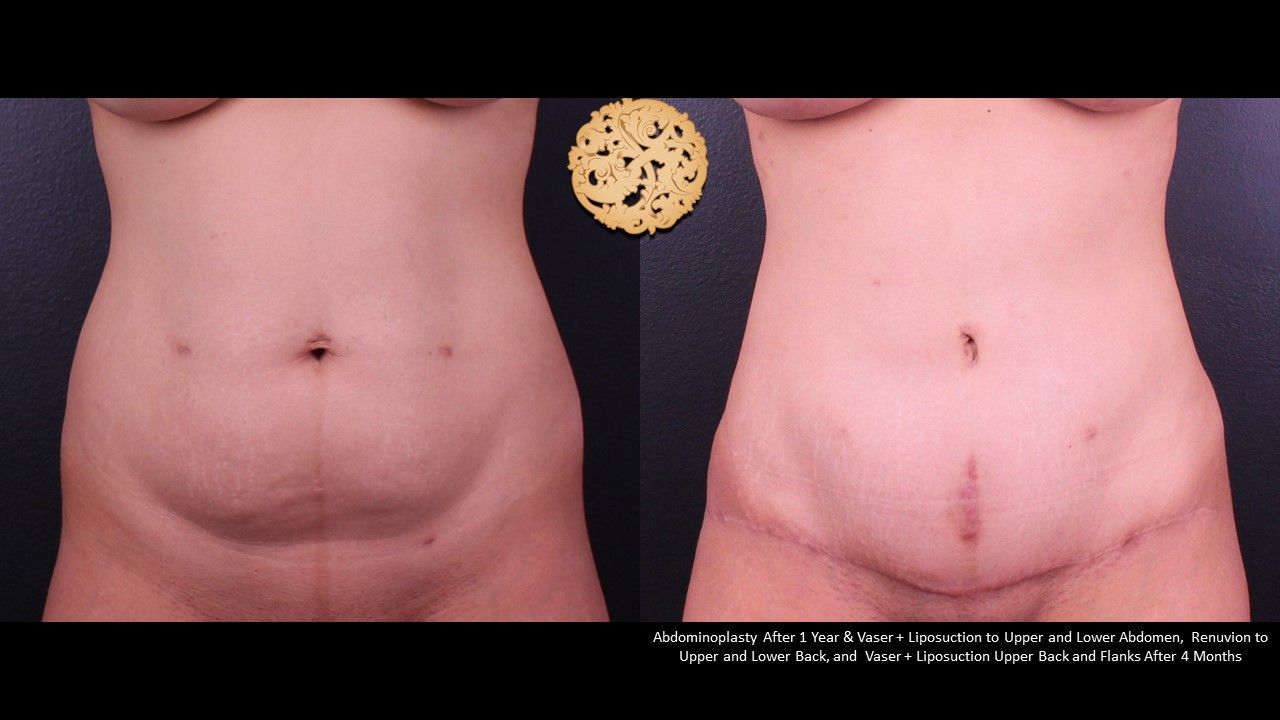 Liposuction Trunk Before & After