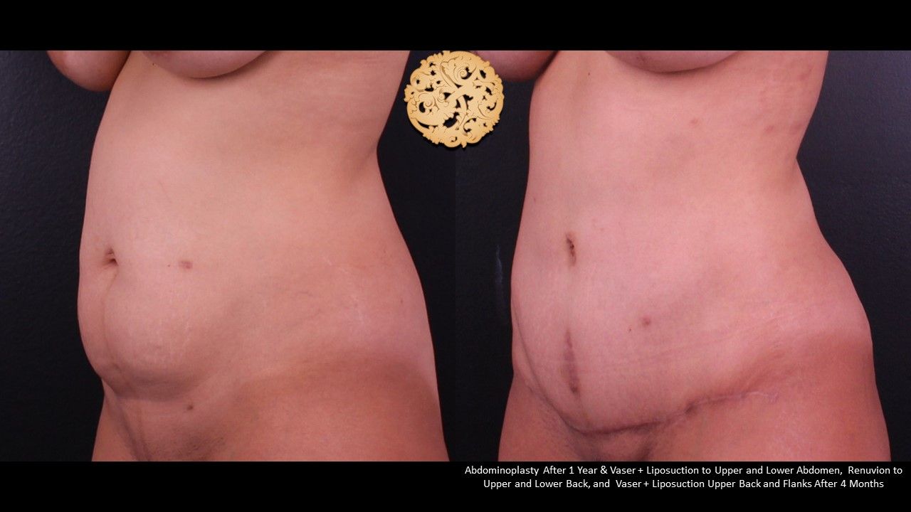 Liposuction Trunk Before & After