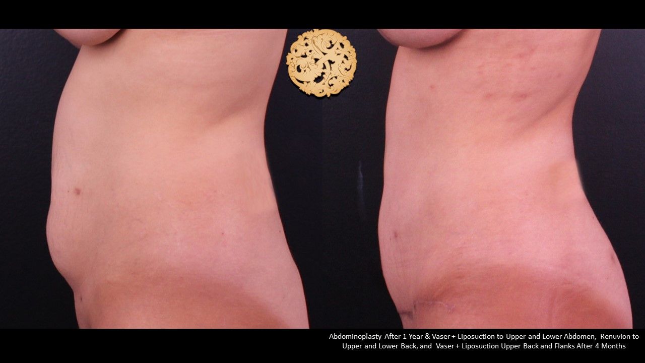 Liposuction Trunk Before & After