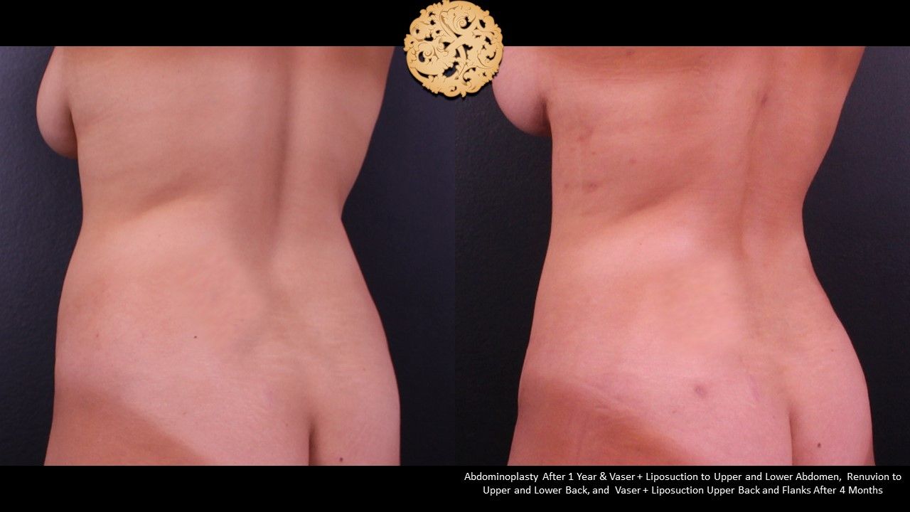 Liposuction Trunk Before & After