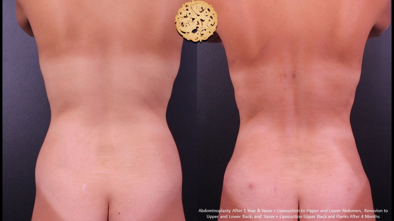 Liposuction Trunk Before & After