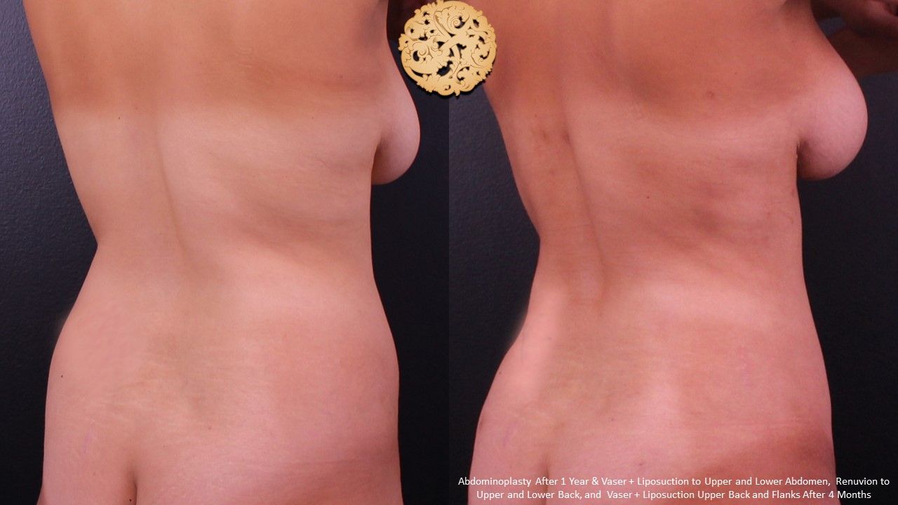 Liposuction Trunk Before & After