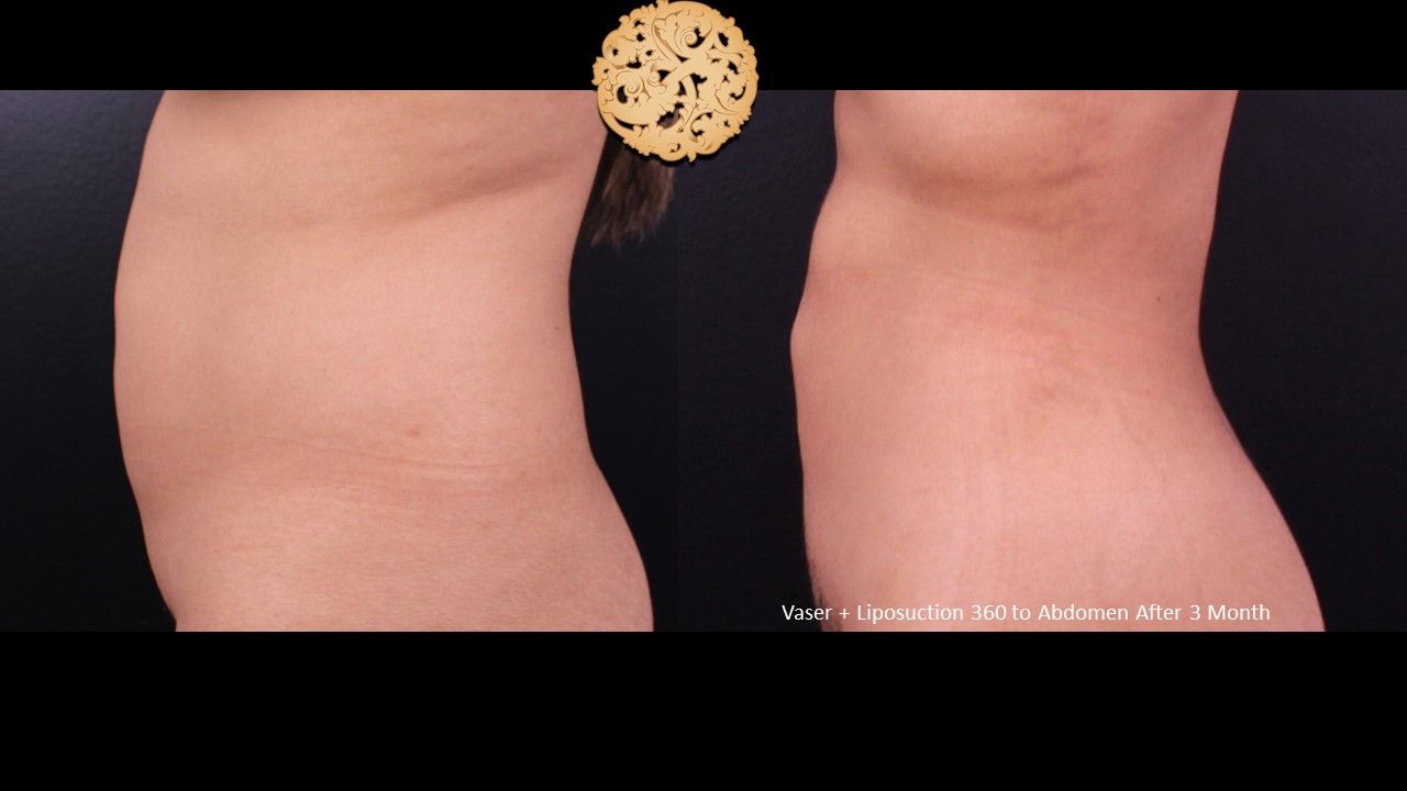 Liposuction Trunk Before & After
