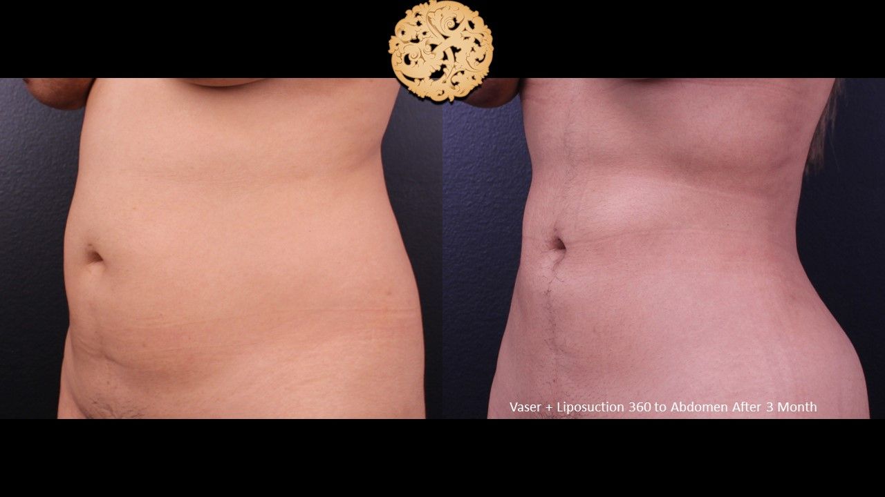 Liposuction Trunk Before & After
