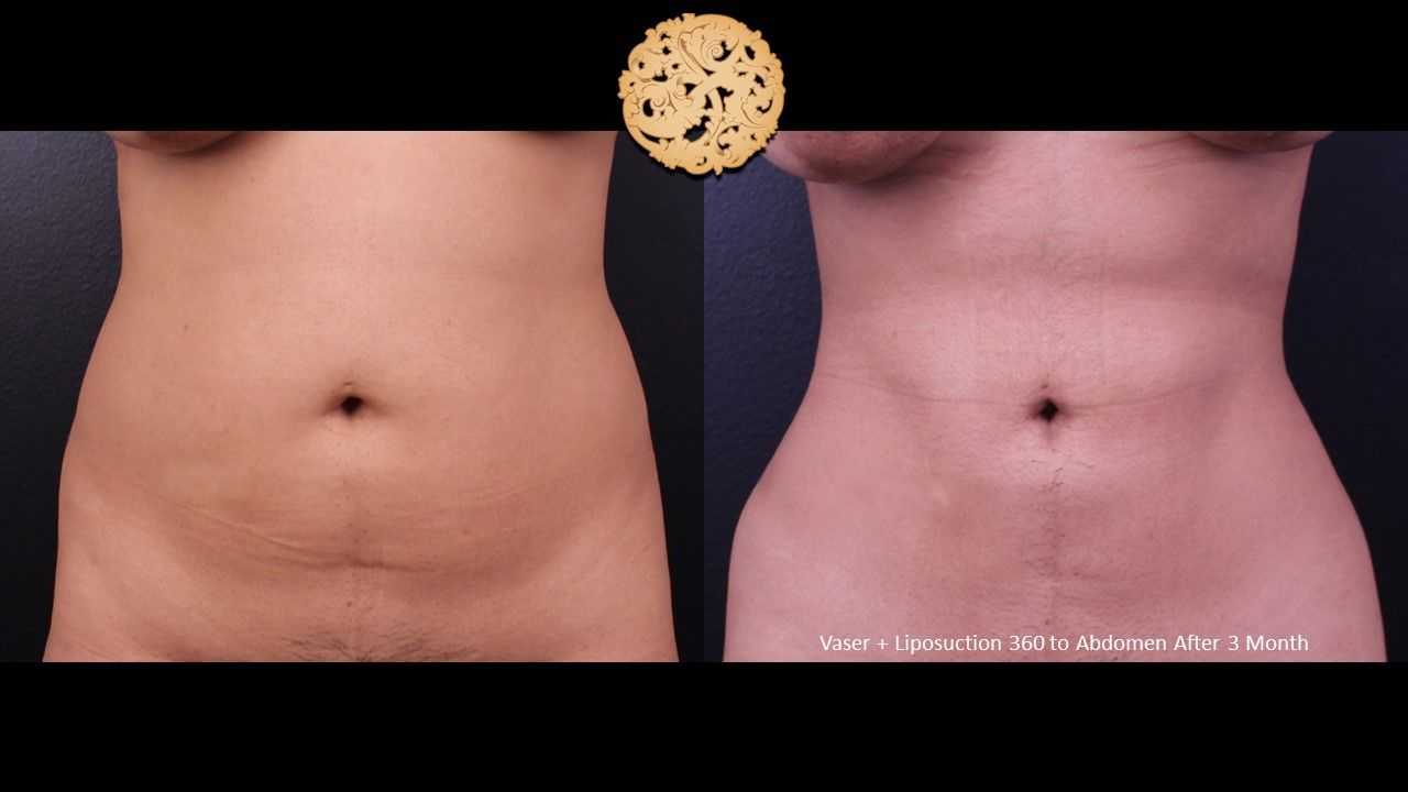 Liposuction Trunk Before & After