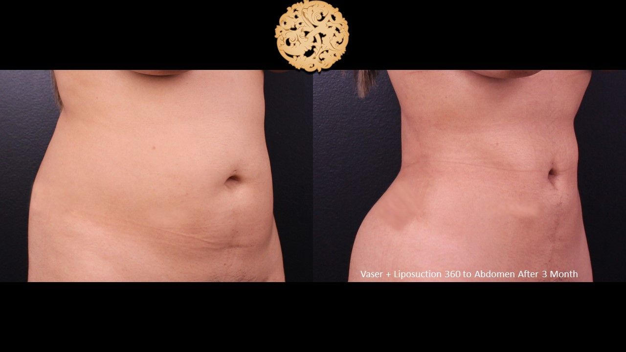 Liposuction Trunk Before & After