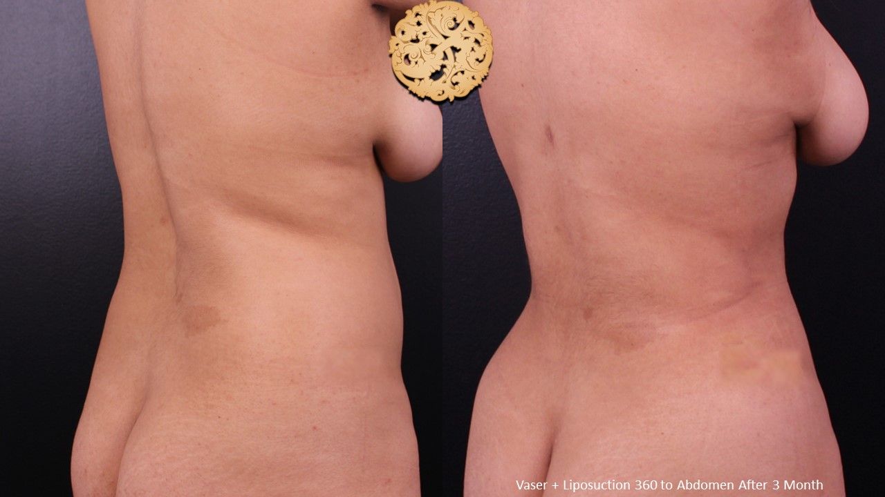 Liposuction Trunk Before & After
