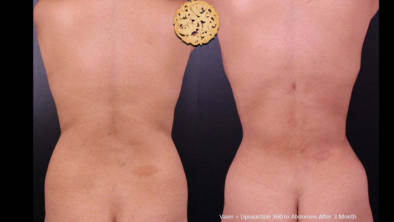 Liposuction Trunk Before & After
