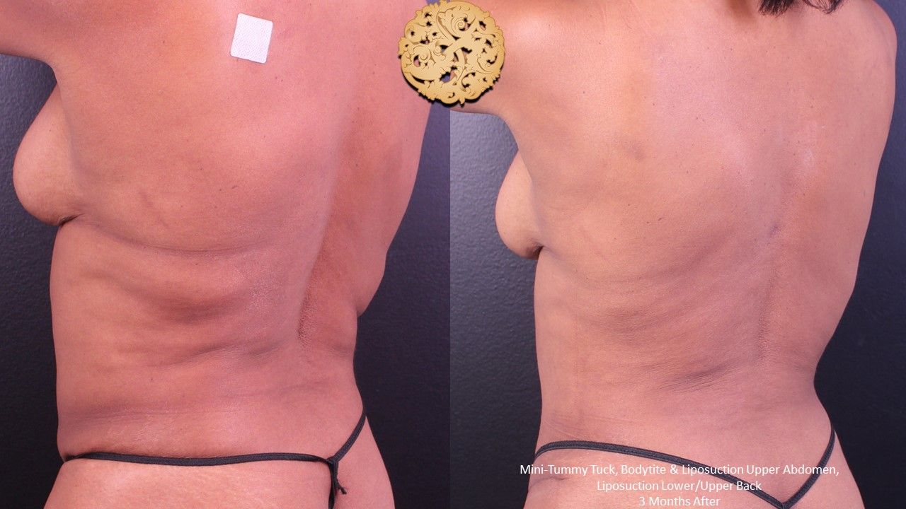 Liposuction Trunk Before & After