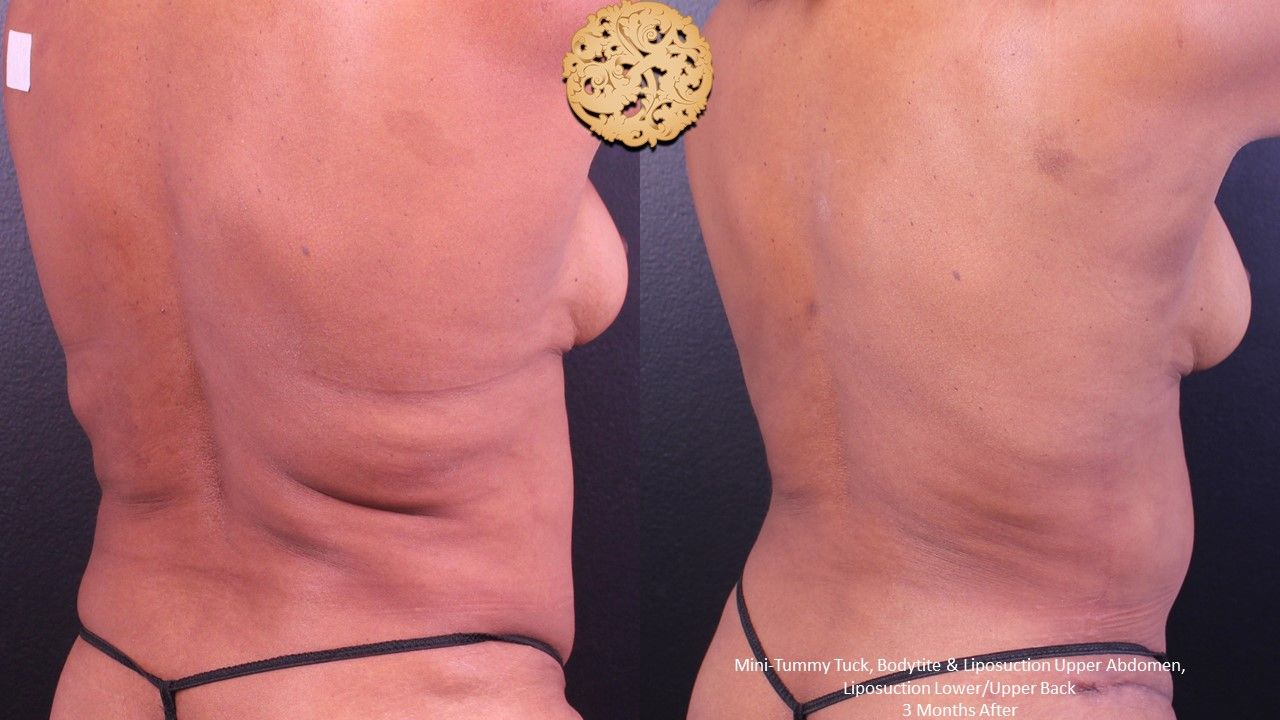 Liposuction Trunk Before & After