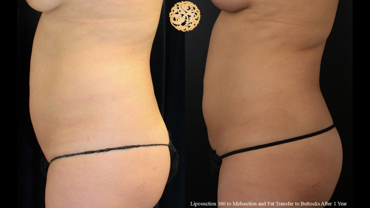 Liposuction Trunk Before & After